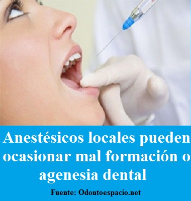 Anestésicos locales pueden ocasionar mal formación o agenesia dental