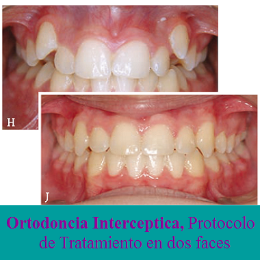 Ortodoncia Interceptica, Protocolo de Tratamiento en dos faces