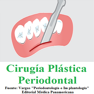 CIRUGÍA PLÁSTICA PERIODONTAL
