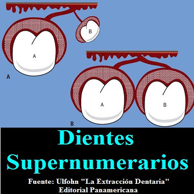 DIENTES SUPERNUMERARIOS